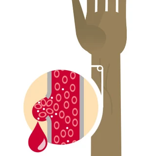 Illustratie die een bloeding uit een bloedvat toont, zoals bij hemofilie
